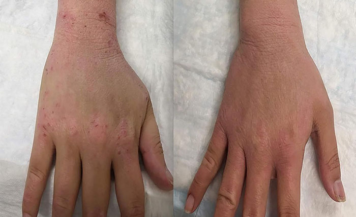 Hand and wrist of a participant in the pilot study before (left) and after (right) treatment of topical steroid withdrawal symptoms with berberine, a mitochondrial complex I-blocking drug