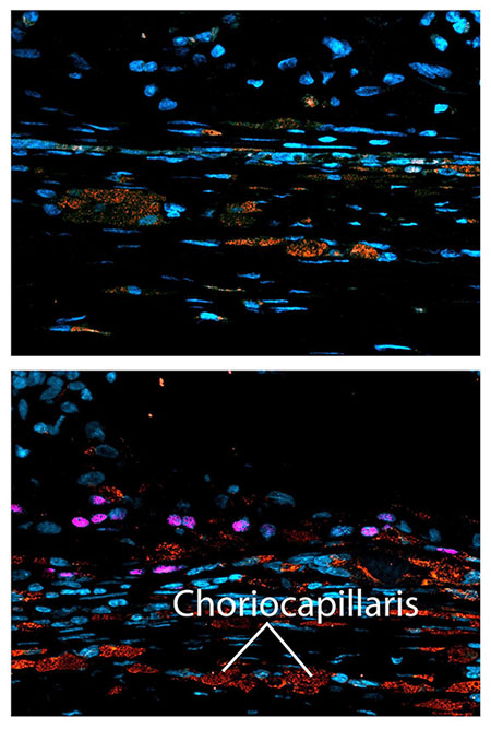 Top image shows the scaffold-only, which served as a control. Bottom image shows how the scaffold with RPE regenerated the choriocapillaris (labeled red), the part of the eye that supplies the retina with oxygen and nutrients